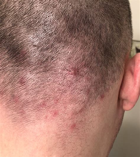 Scalp Acnefolliculitis Pictures Page 2 General Acne Discussion