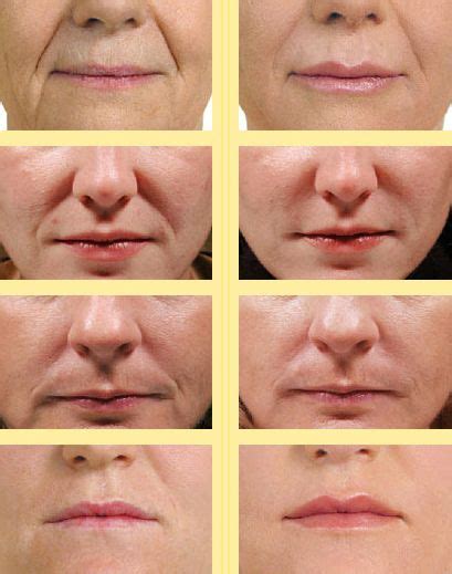 Face Workouts To Prevent And Fade Nasolabial Folds And Smile Lines