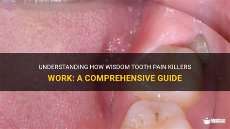 Understanding How Wisdom Tooth Pain Killers Work A Comprehensive Guide