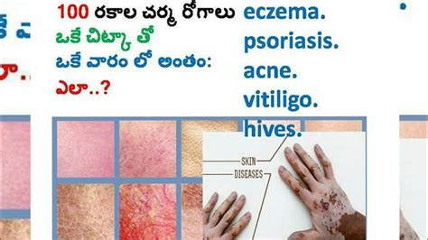 All Types Of Skin Diseases అన్ని రకాల చర్మ వ్యాధులకు ఒకే ఒక్క చిట్కా