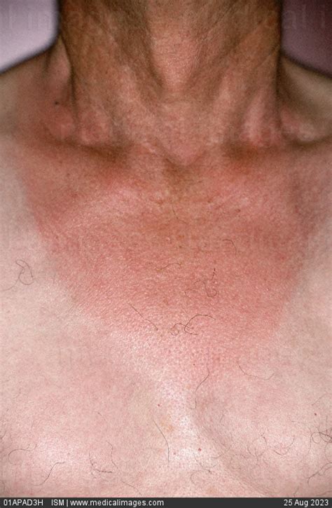 Stock Image Phototoxic Erythema Neck Region This Sunburn Was Caused By