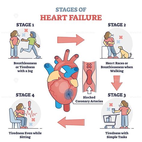 Stages Of Heart Failure And Symptoms With Cardiology Stroke Outline
