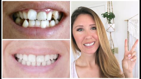 Invisalign Before And After Invisalign® Before And After Dentist