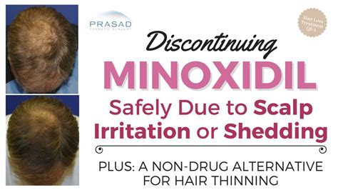What Happens When We Stop Using Minoxidil