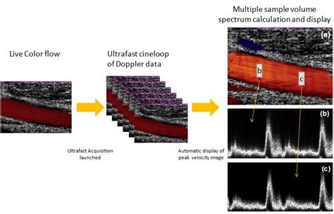 Ultrafast Ultrasound Imaging Intechopen