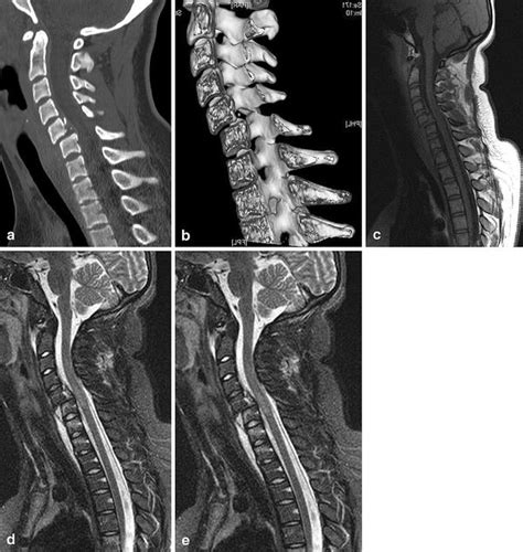 Trauma Of The Spine And Spinal Cord Imaging Strategies Springerlink