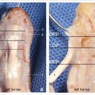 Flexor tendon injuries still remain a challenging condition to manage to ensure optimal outcome for the patient. Division of the distal part of flexor digitorum longus ...