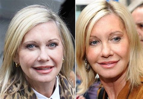 Olivia Newton John Plastic Surgery Before And After Pictures