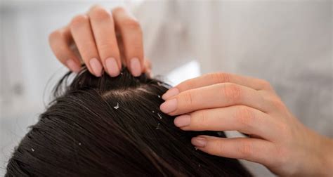 Micose no couro cabeludo o que é sintomas e tratamentos MundoBoaForma