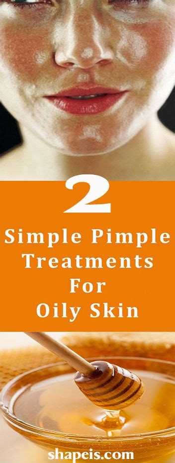 2 Simple Pimple Treatments For Oily Skin Oily Skin Treatment Pimple Treatment Oily Skin