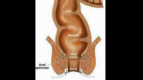 Rectal Cancer An Overview Los Angeles Colonoscopy Youtube