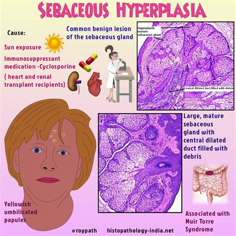 Sebaceous Hyperplasia Is A Common Benign Lesion Of Sebaceous Glands In