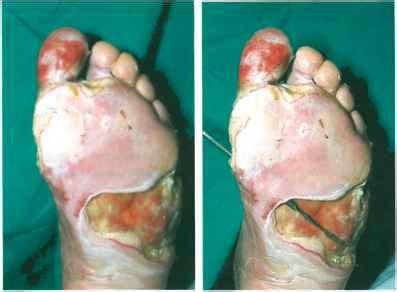 A rapidly progressive infection primarily involving the fascia and subcutaneous tissue. Necrotizing fasciitis in a previously neuropathic foot that had become neuroischaemic - Diabetic ...