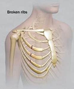 Broken Ribs New Health Guide