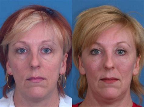 Eyelid Lifts Before And Afters Raval Facial Aesthetics Denver