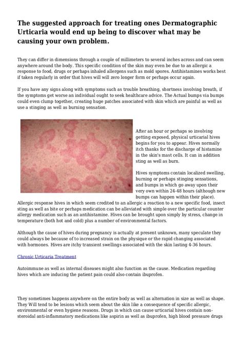 The Suggested Approach For Treating Ones Dermatographic Urticaria Wo