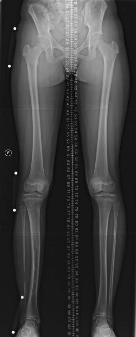 Scanogram Knee