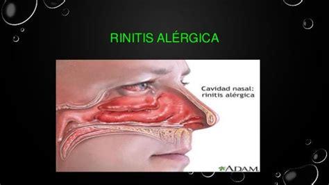 Rinitis Alérgica Y Sinusitis