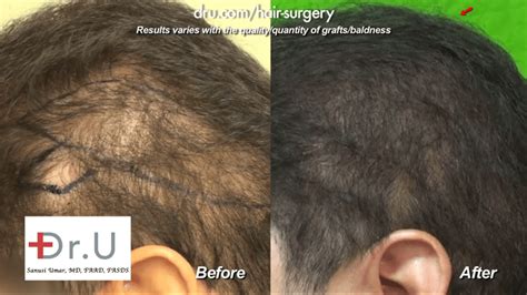 Video Hair Transplant Using Beard Hair In Los Angeles