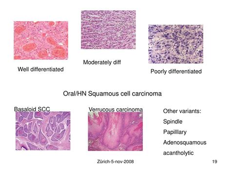 Ppt Squamous Cell Carcinoma In The Oral Cavity And Cervix Powerpoint