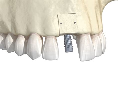 5 Tips For Recovering From A Bone Graft For Dental Implants