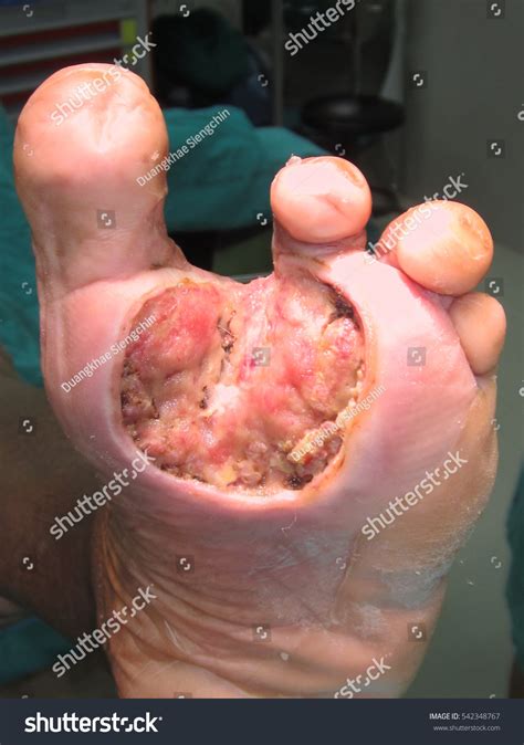 Diabetic Foot Pain And Ulcers Skin Sores On Foot Side View My XXX Hot