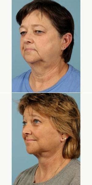 55 64 Year Old Woman Treated With Facelift With Dr Suzanne Yee Md