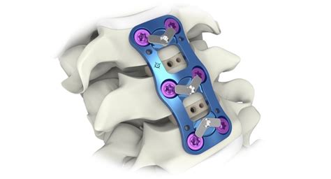 Aurora Spine Receives Fda 510k Clearance For Anterior Cervical Plate