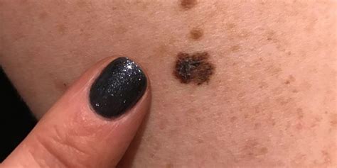 Esthetician Shares Photo Of Clients Mole To Warn Against Skin Cancer