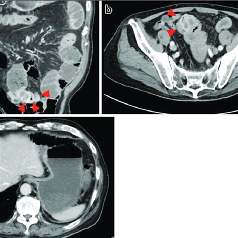 Contrast Enhanced Abdominal Ct At Diagnosis Showed A Mass Of 50 Cm In