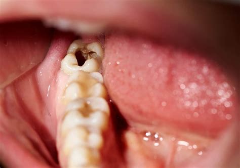What Causes A Tooth Infection