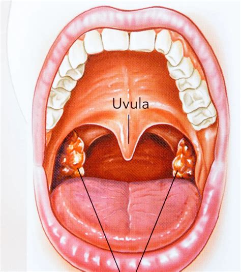 Bacterial Tonsillitis Tongue