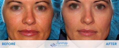 Ipl Laser Photo Rejuvenation Synergy Primary Care And Wellness
