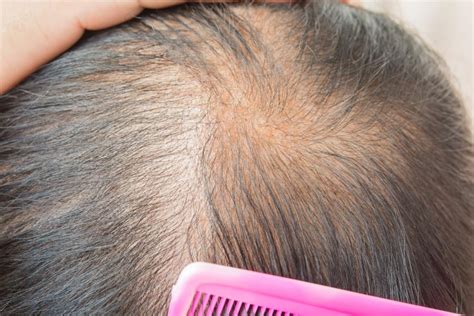The hair's growing phase, called anagen, decreases and may lead to follicular miniaturization. Thinning hair: Causes, types, treatment, and remedies