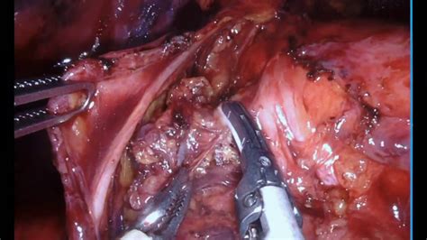 Robotic Mediastinal Lymph Node Dissection In Lung Cancer Surgery Youtube