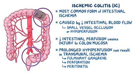 Ischemic Colitis Clinical Sciences Osmosis Video Library