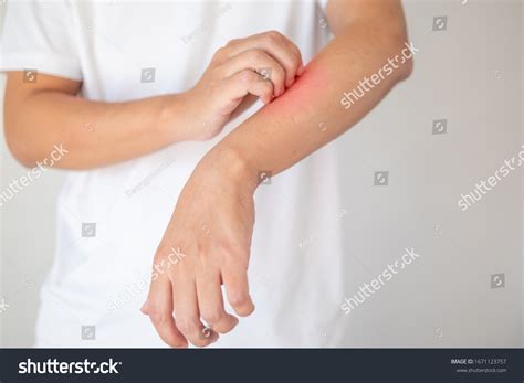 Man Itching Scratching On Arm Itchy Stock Photo 1671123757 Shutterstock