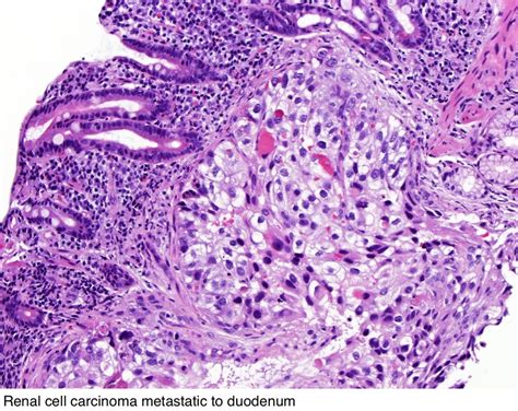 Pathology Outlines Renal Cell Carcinoma Overview