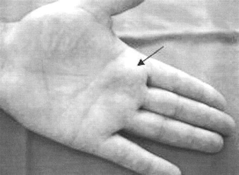 Unusual Subcutaneous Swellings On The Hand As Primary Presenting