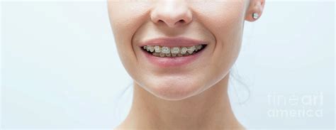 Dental Braces Photograph By Peakstock Science Photo Library Fine Art America