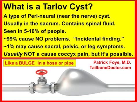 How To Tell Tarlov Cyst Pain From Tailbone Pain Coccyx Pain