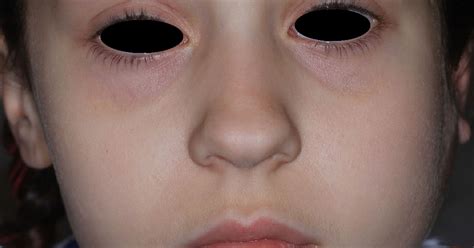 Girl Presents With Swelling On Left Side Of Her Face Occasional Fever