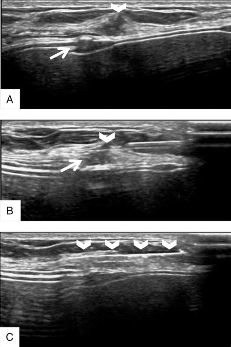 Ultrasound‐guided Breast Biopsies Bhatt 2021 Journal Of