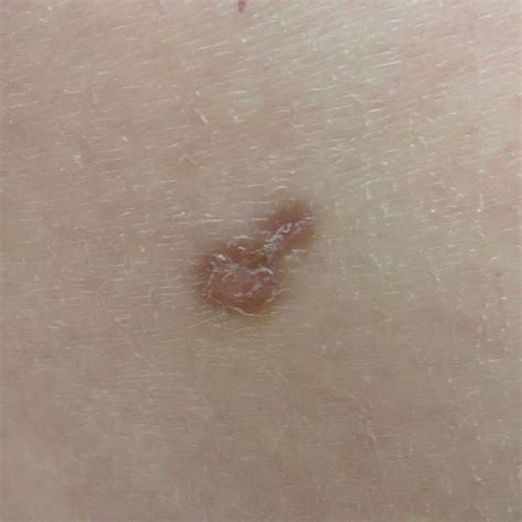 What Do Red Spots On Skin Mean 13 Skin Spots Bumps Pictures Ph