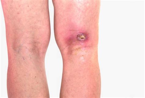Venous Ulcers Leg Ulcers Arterial Disease Houston Tx