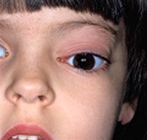 Causes Of Facial Swelling In Pediatric Patients Correlation Of Clinical And Radiologic Findings