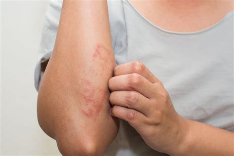 Common Skin Allergies And Treatments In Mysore Reniu Skin Laser