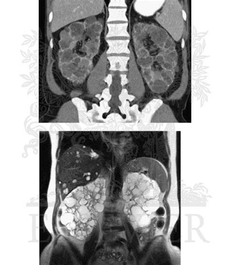 Polycystic Kidney Disease Radiographic Findings