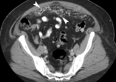 Primary Peritoneal Tumors Imaging Features With Pathologic Correlation
