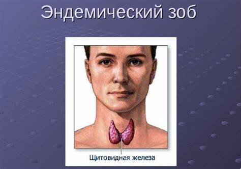 Зоб 2 степени диета Зоб 2 степени диета